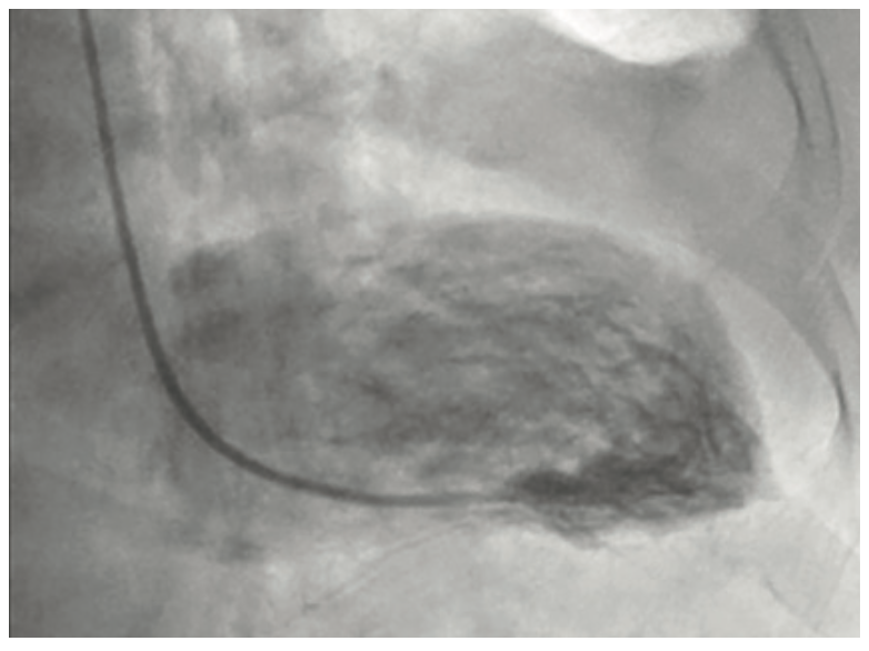 Ibrahim Aneurysm Figure 8