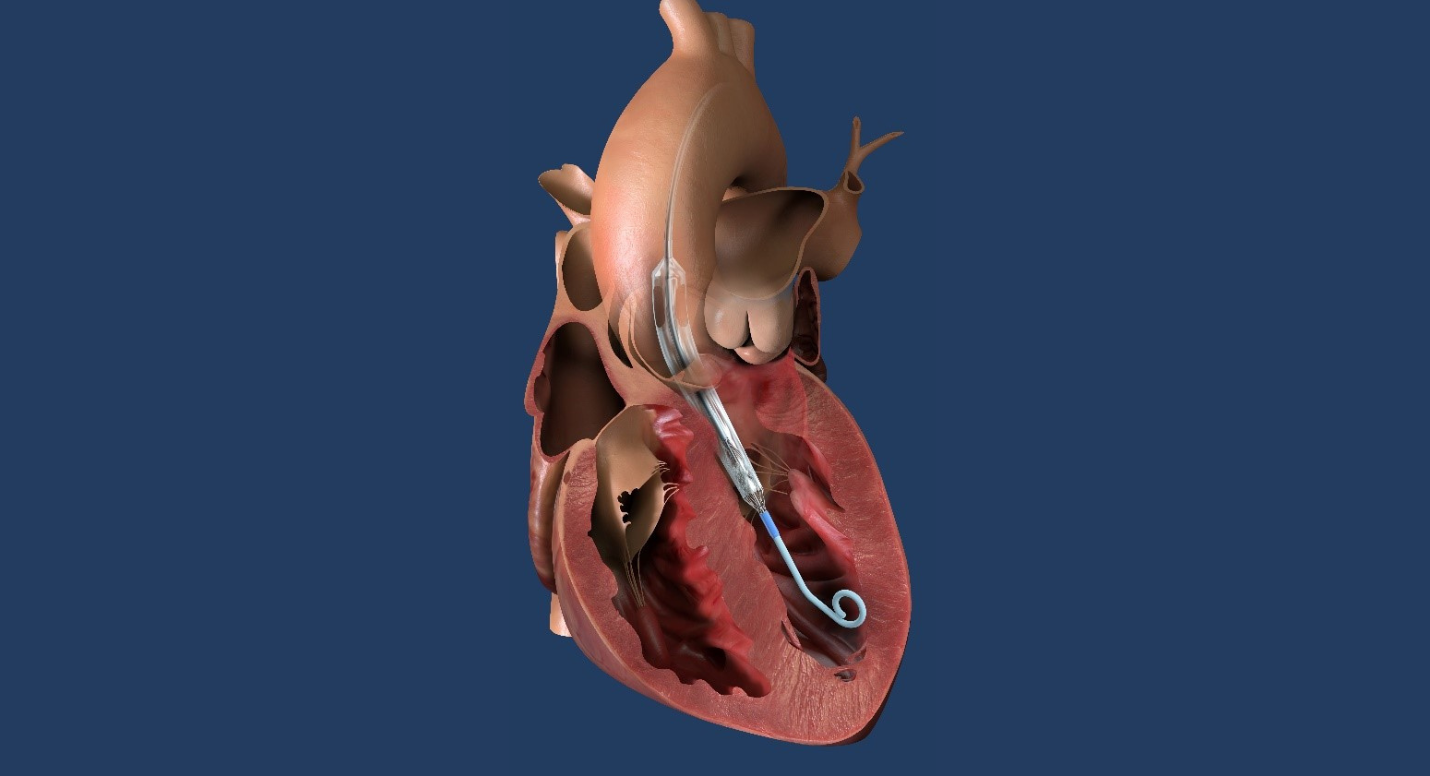Impella ECP