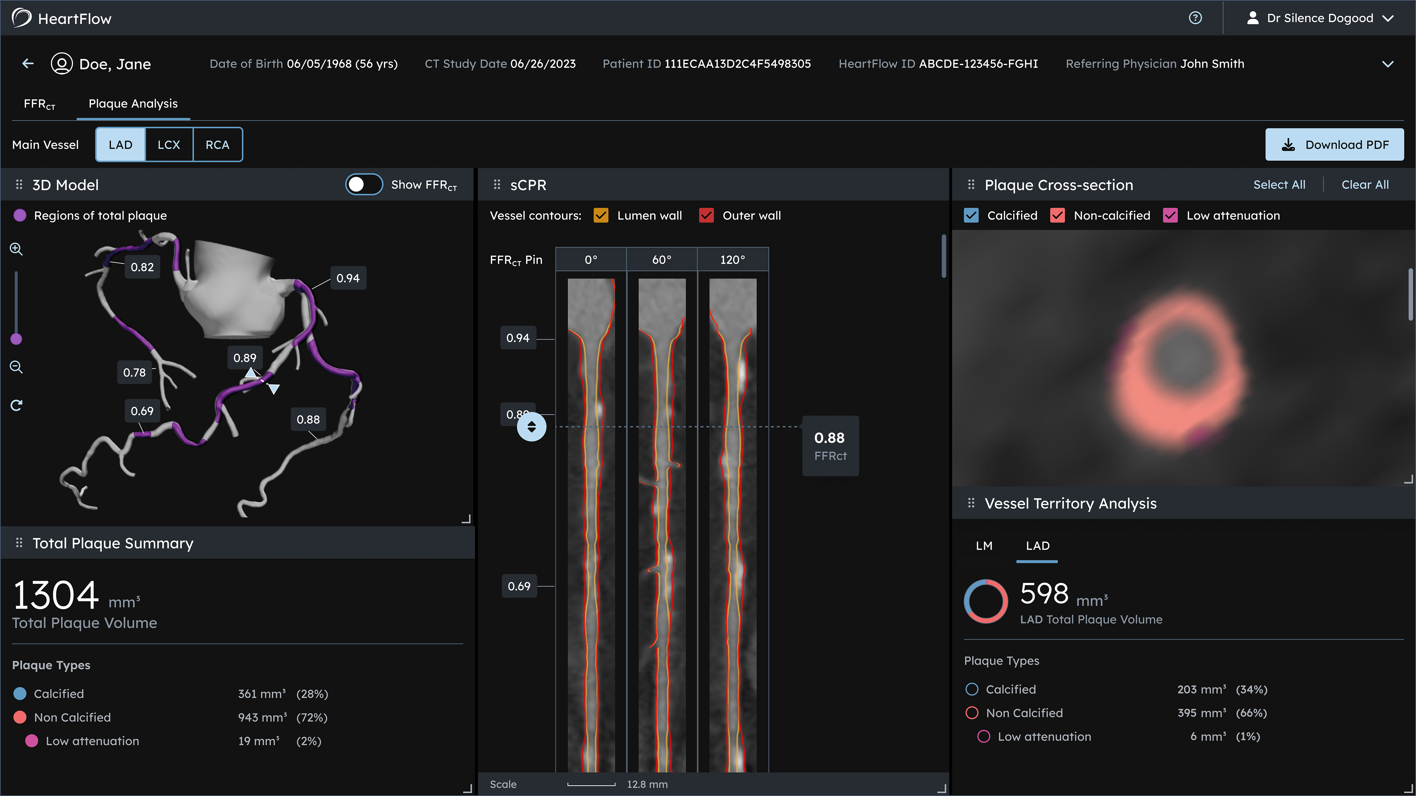 Interactive Plaque Dashboard - courtesy HeartFlow