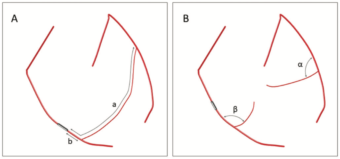 Ioppolo Chronic Total Occlusion Figure 2