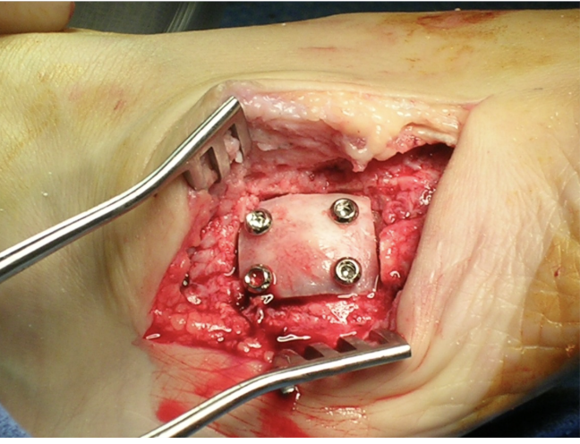 This image shows an isolated arthrodesis of the TMT 4-5 joint. 