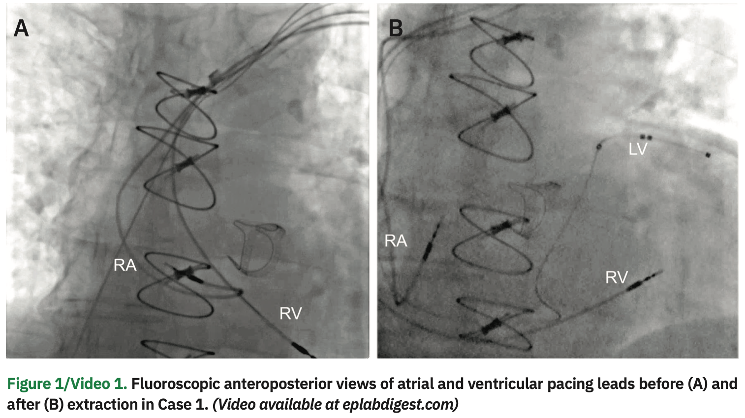 Issa Transvenous Lead Figure 1