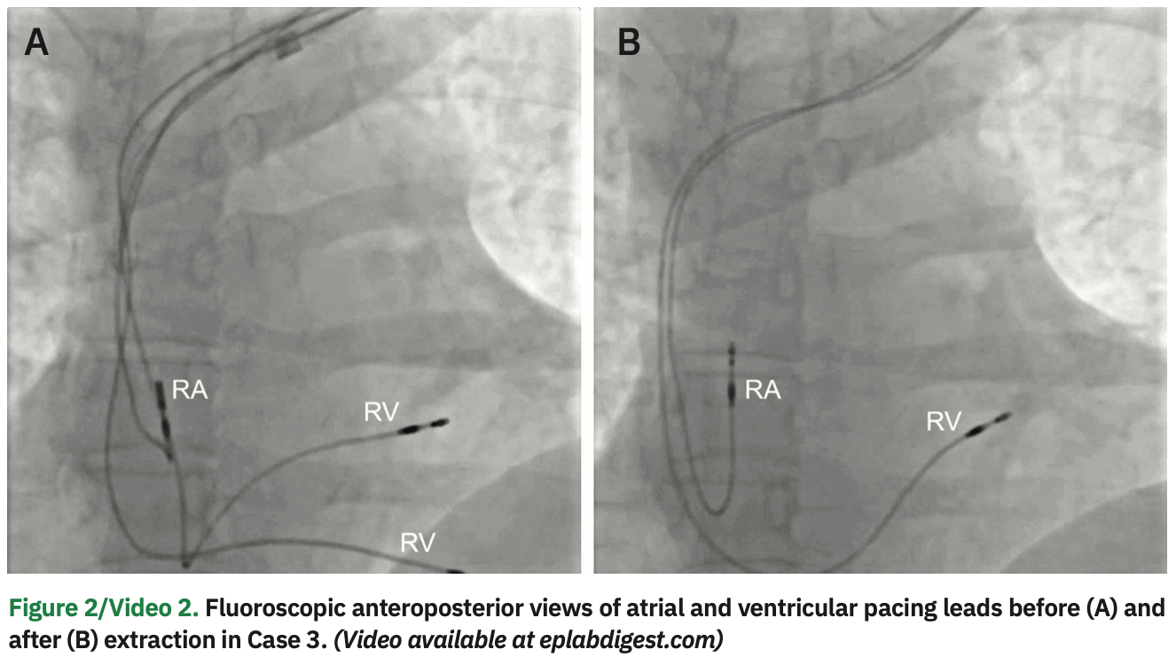 Issa Transvenous Lead Figure 2