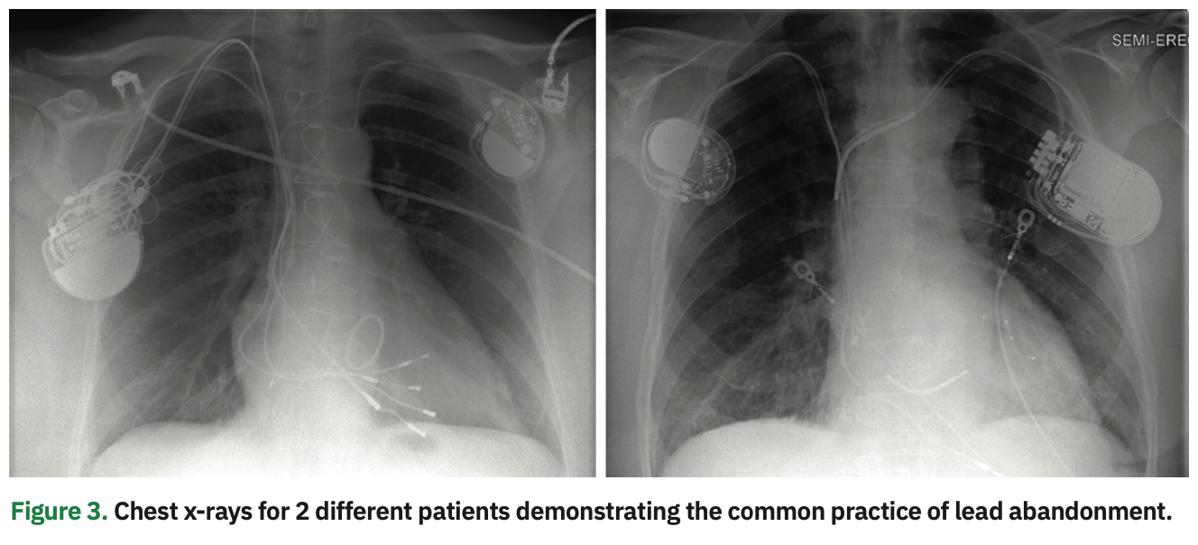 Issa Transvenous Lead Figure 3