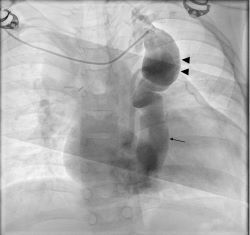 Figure 1. Glenn angiogram