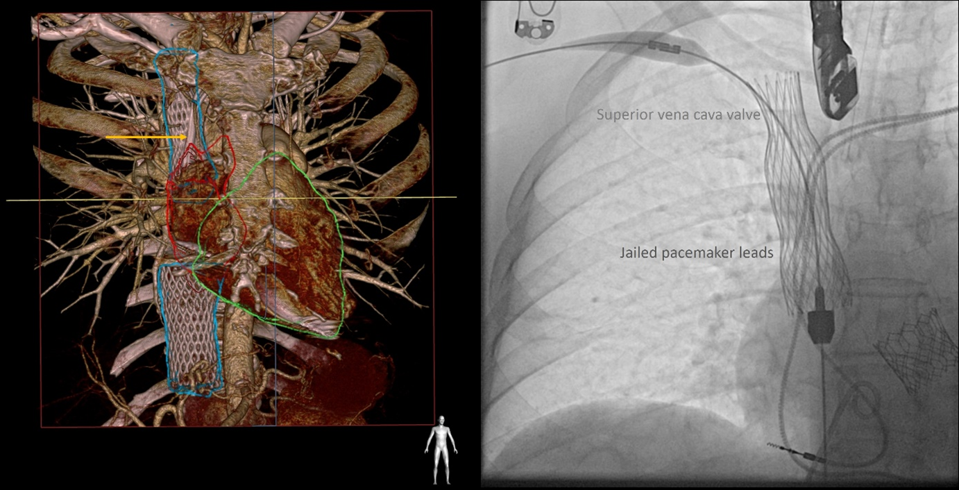 Figure. (A) Computed tomography angiography