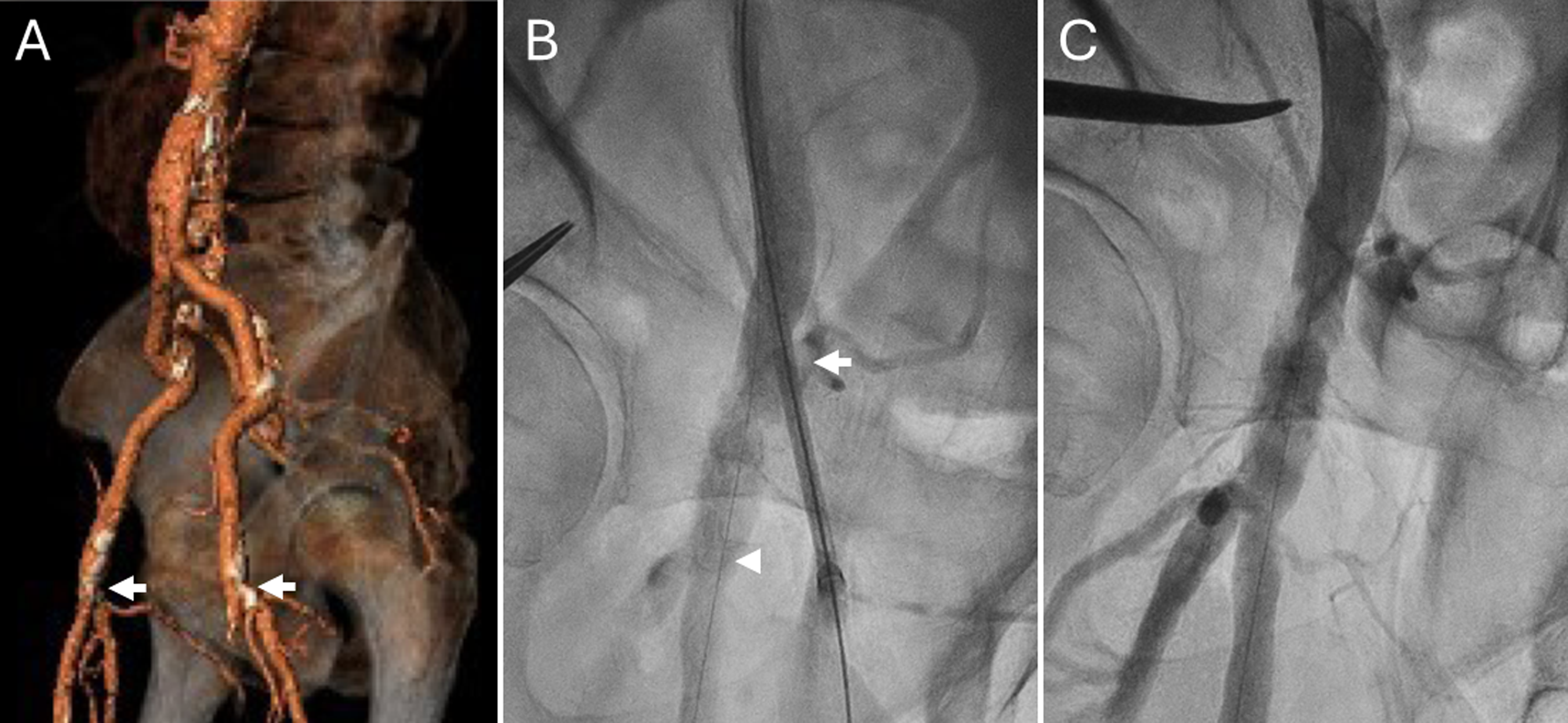 Figure 2. Case 2: A 68-year-old man with severe aortic stenosis