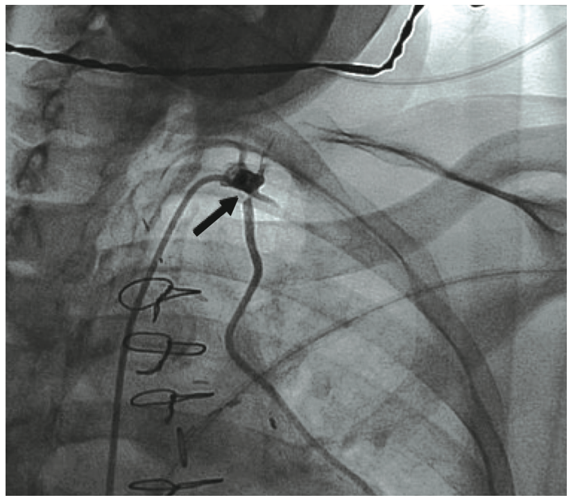 Jain Mammary Artery Graft Figure 1A