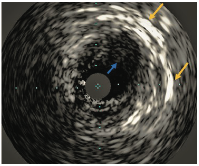 Jain Mammary Artery Graft Figure 1B