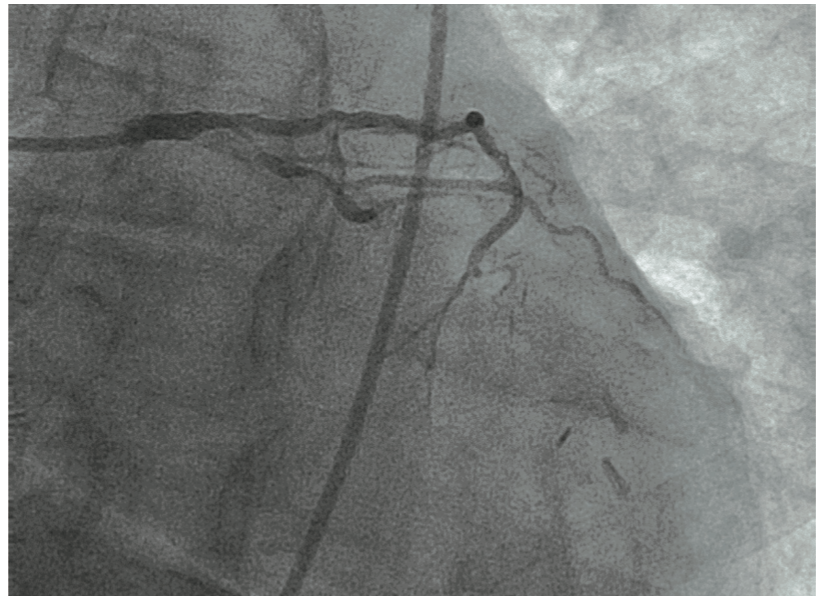 Jain Mammary Artery Graft Figure 2