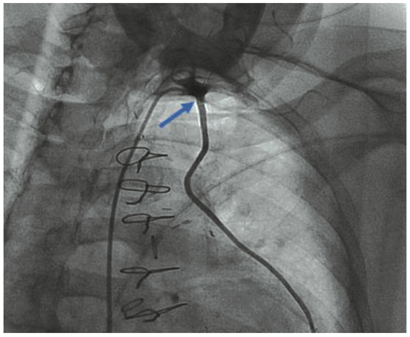 Jain Mammary Artery Graft Figure 3A