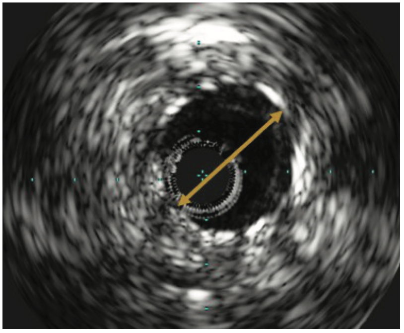 Jain Mammary Artery Graft Figure 3B