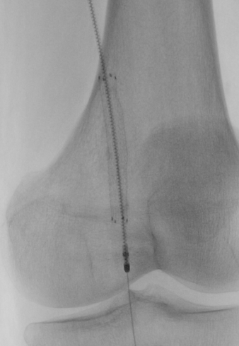 Figure 1. Rotarex atherectomy system (BD). 