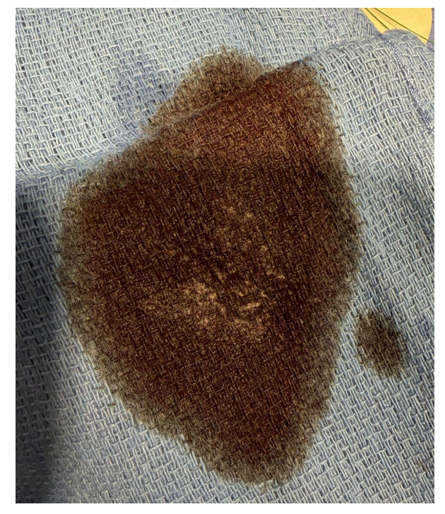 Figure 3. Temporary occlusive embolectomy technique embolic residue.