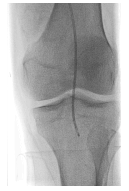 Figure 4. Temporary occlusive embolectomy technique.