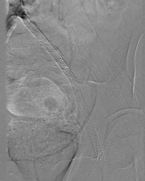 Figure 5. Chronic total occlusion prior to intervention.