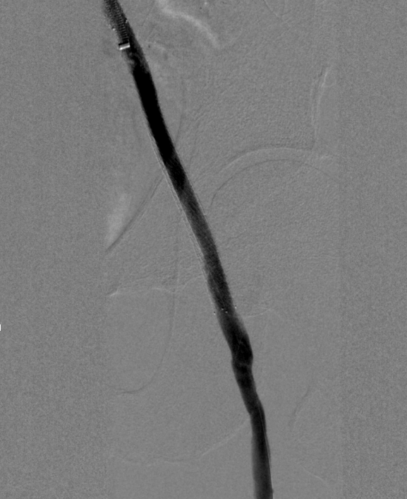 Figure 6. Chronic total occlusion post-intervention. 