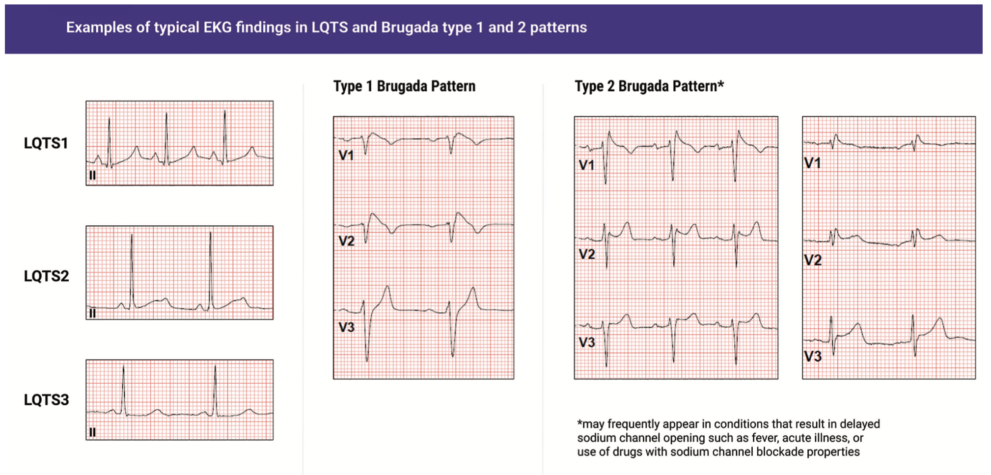 Jankelson Inherited Arrhythmia Syndromes Figure 2