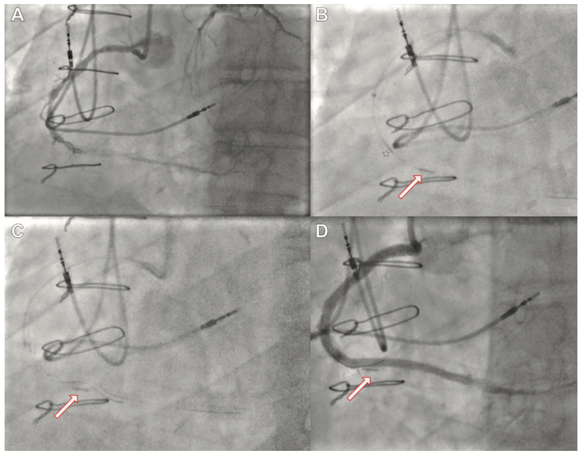Kaier Antegrade Dissection Figure 1