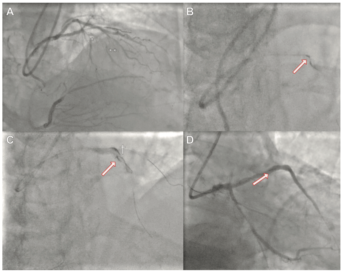 Kaier Antegrade Dissection Figure 2