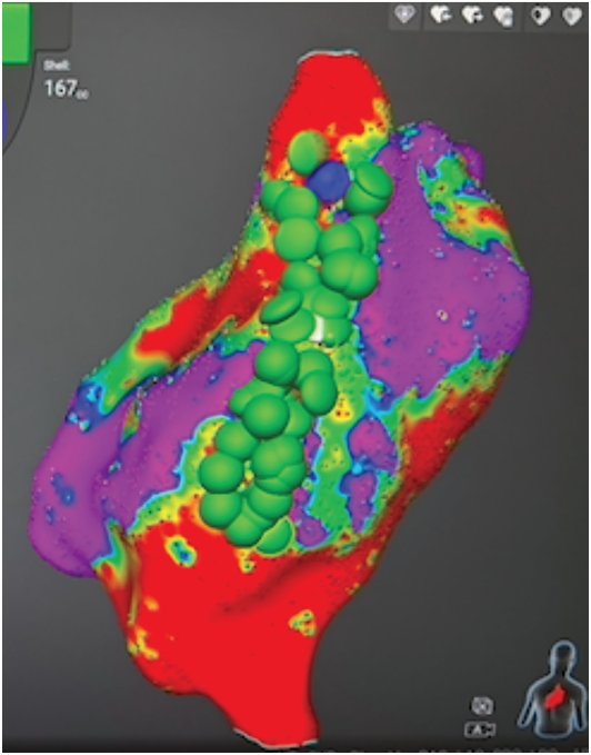 Figure 2. Linear ablation along the posterior wall using a pulse field ablation resulted in termination of the flutter.