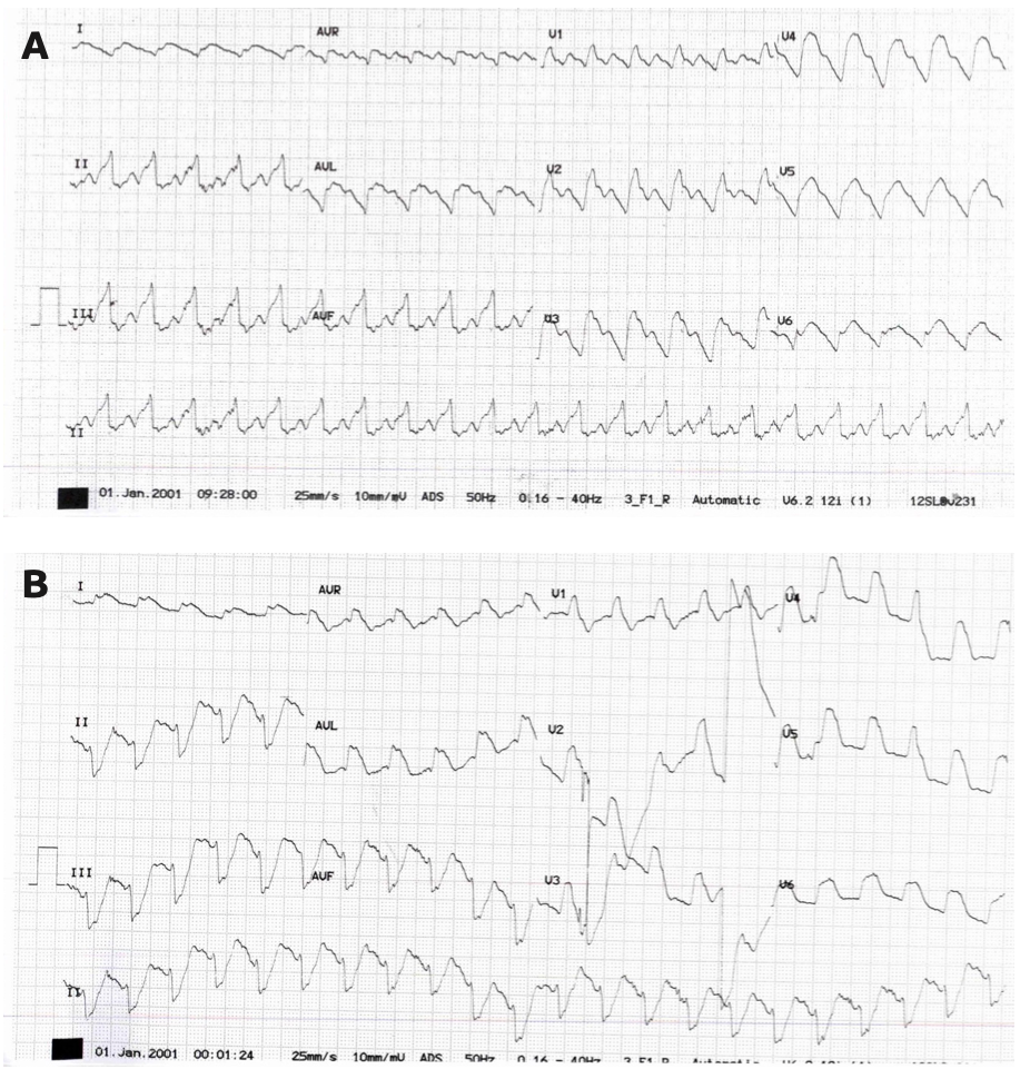 Kanjanarutjawiwat STEMI Figure 1