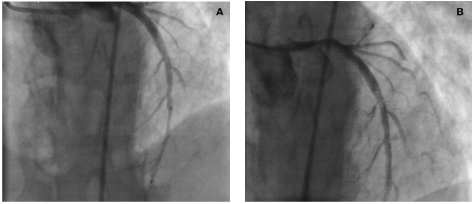 Kanjanarutjawiwat STEMI Figure 2
