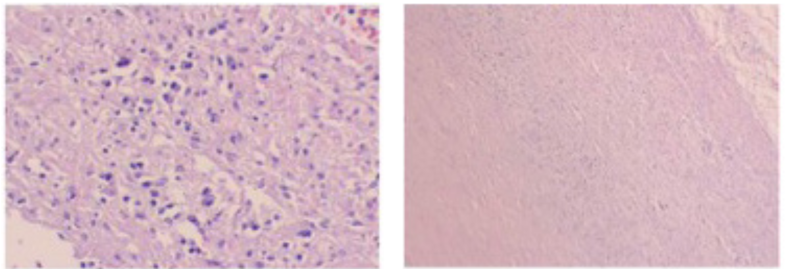 Kanjanarutjawiwat STEMI Figure 4