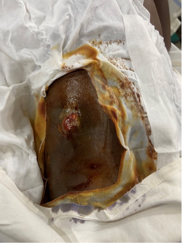 Figure 1. Clinical photograph showing nonhealing anterior abdominal wall sinus in right iliac fossa.