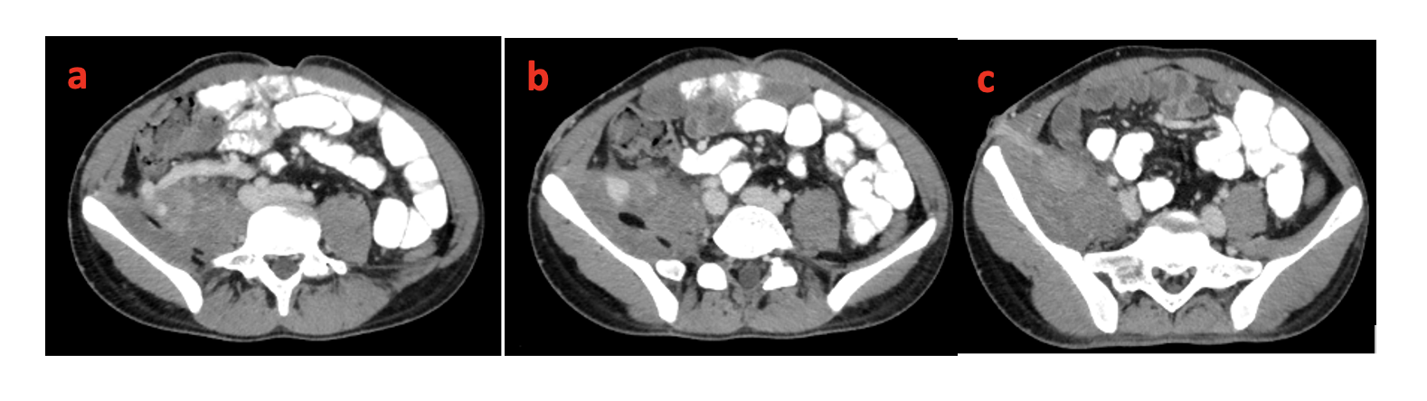 Figure 2. Axial contrast-enhanced computed tomography images showing the superior mesenteric vein tributary (a), the afferent vein contributing the varices in the first image, and its communication to the anterior abdominal wall in subsequent images (b,c).
