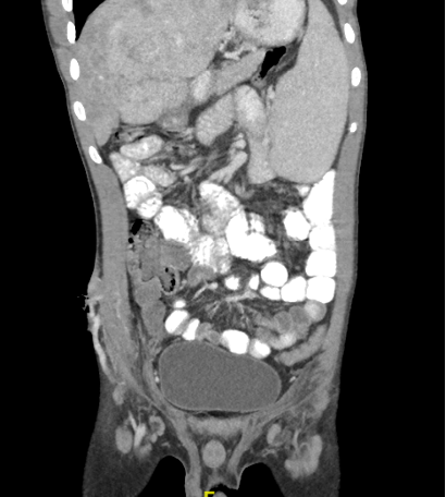 Figure 3. Image showing the efferent vein and dilated inferior epigastric vein along the anterolateral aspect of abdominal wall over the right iliac fossa. Heterogenous nodular liver and splenomegaly are also seen.