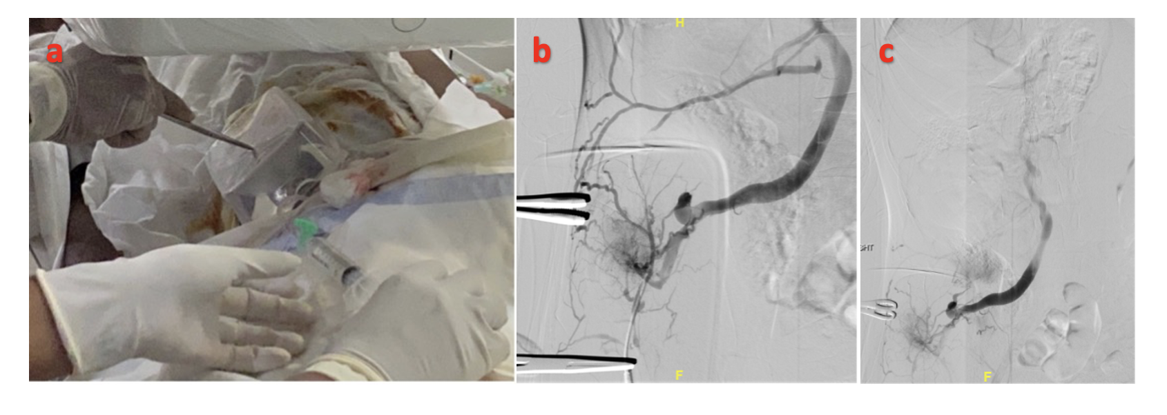 Figure 4. Venogram through the abdominal wall vein after external compression with a radiolucent box (a) showing retrograde opacification of the superior mesenteric vein and portal vein (b,c).