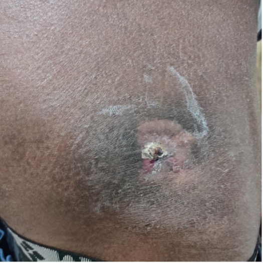 Figure 6. Clinical photograph showing healed sinus after 2 months.