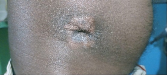 Figure 7. Clinical photograph showing completely healed scar after 1 year.