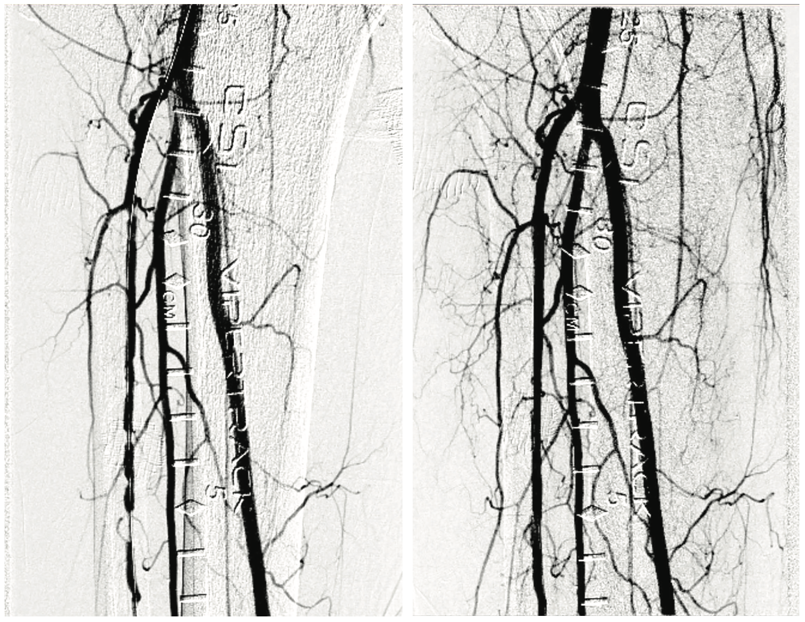 Kapur Peripheral Artery Disease Figure 1