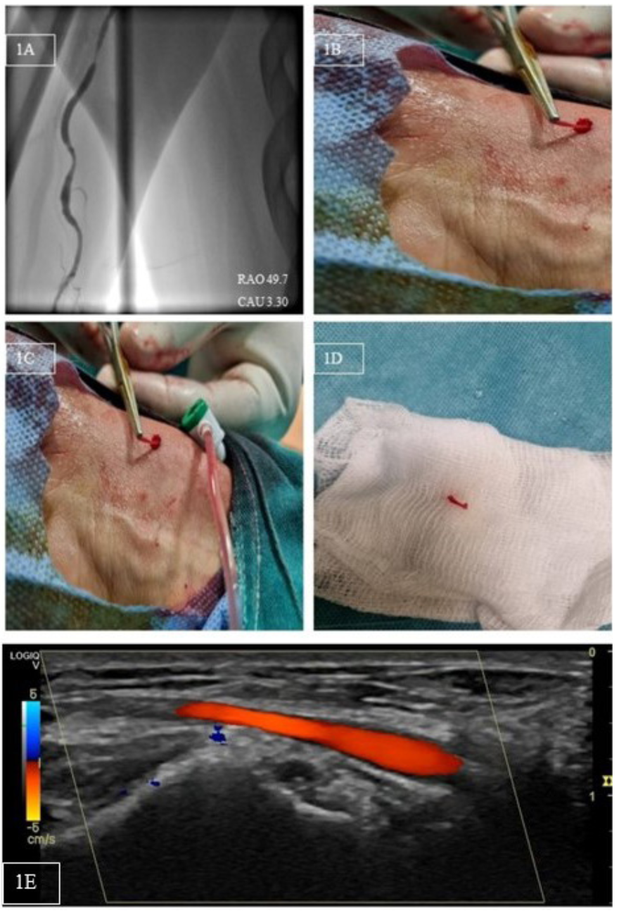 Karelas Avulsed Fragment Figure 1