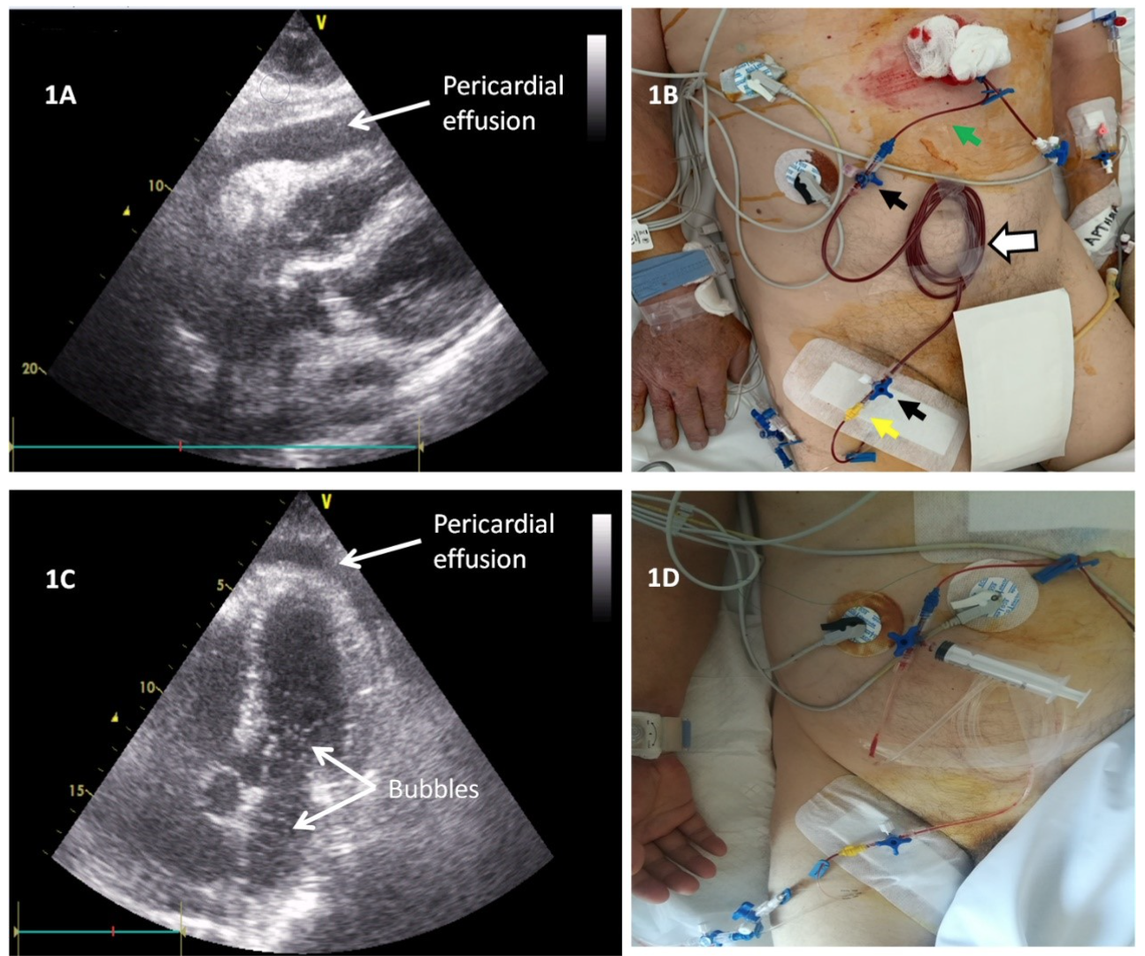 Karelas Hemopericardium Figure 1