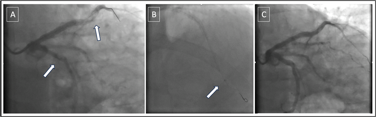Figure. Left coronary angiography