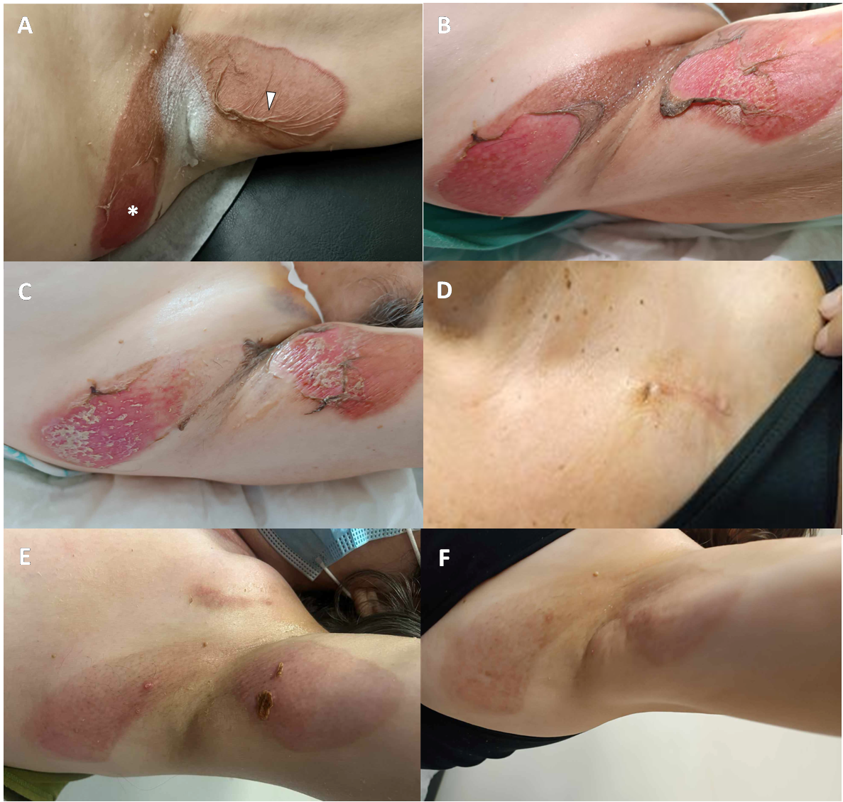 Figure. Clinical progression of a povidone-iodine-induced chemical burn near the pacemaker implantation site. 