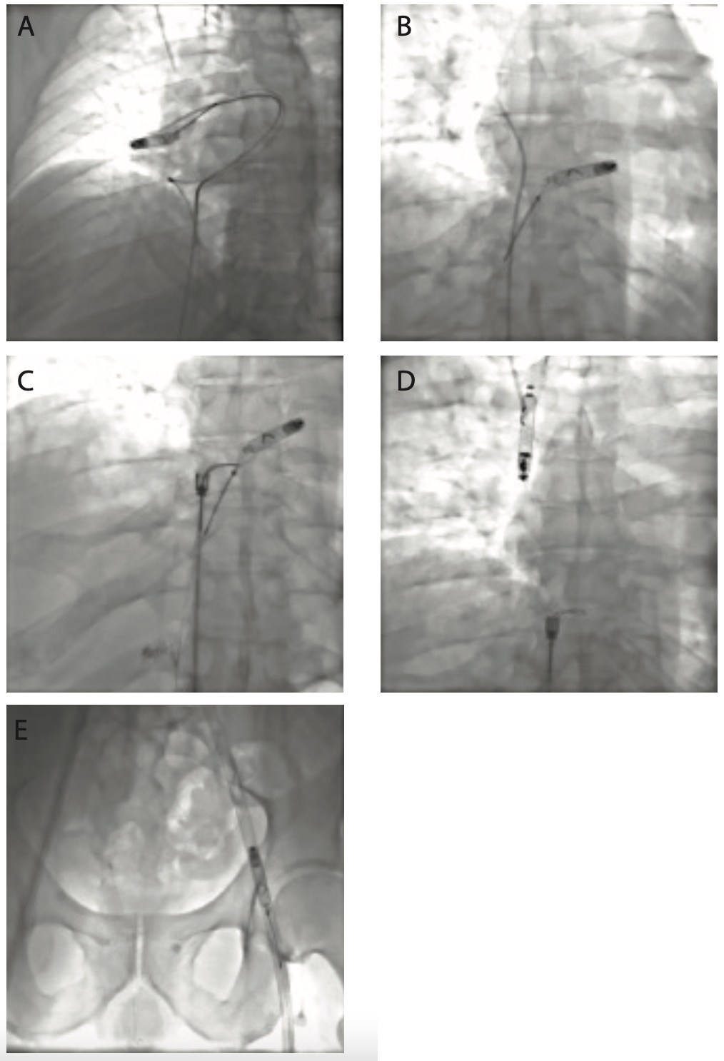 Kasi Leadless Pacemaker Figure 2