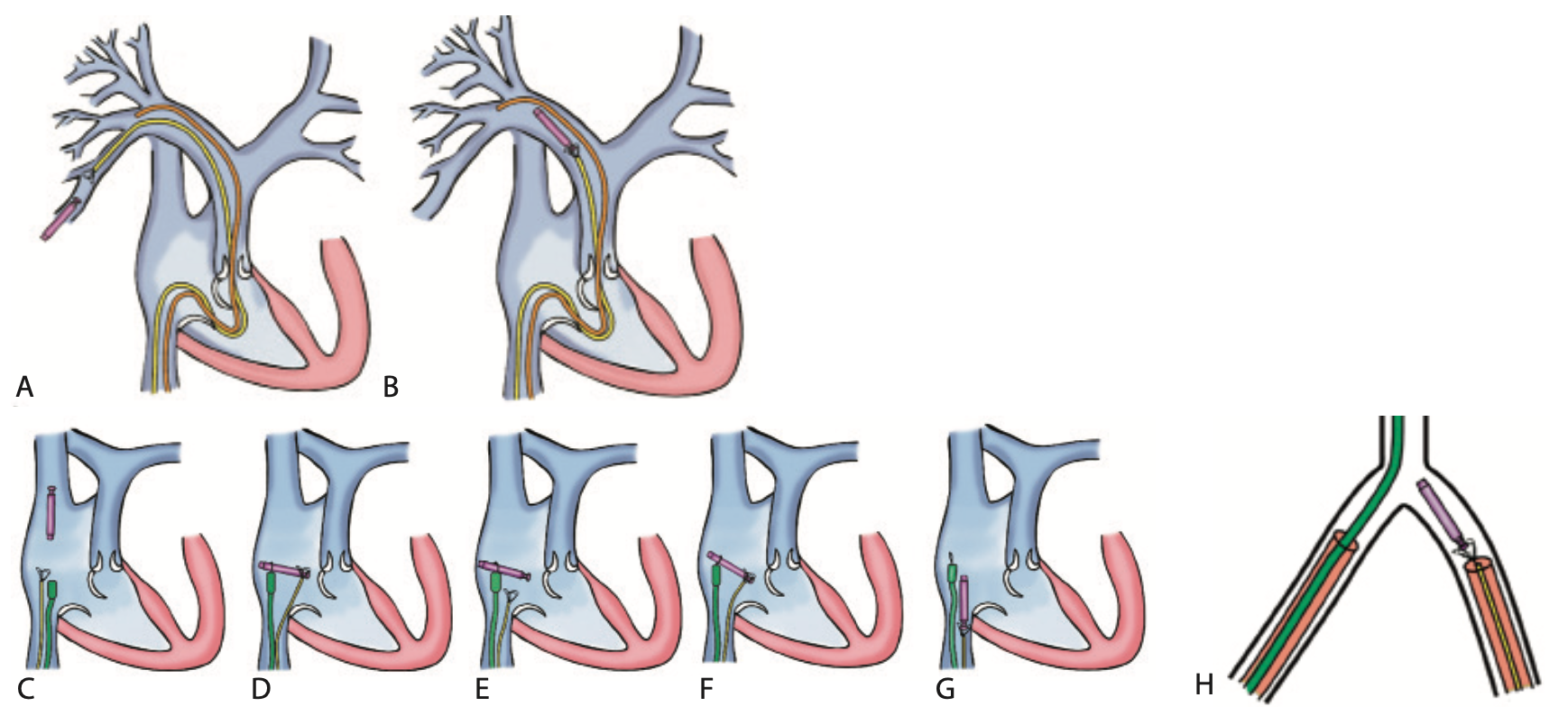 Kasi Leadless Pacemaker Figure 3