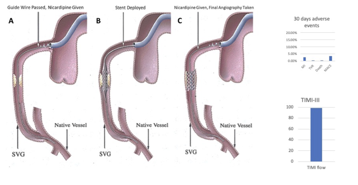 Kassier Saphenous Vein Grafts Figure 5