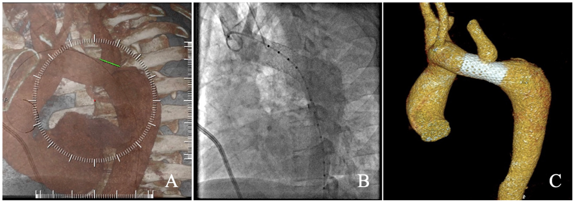 Katsarou Stenting Figure 1