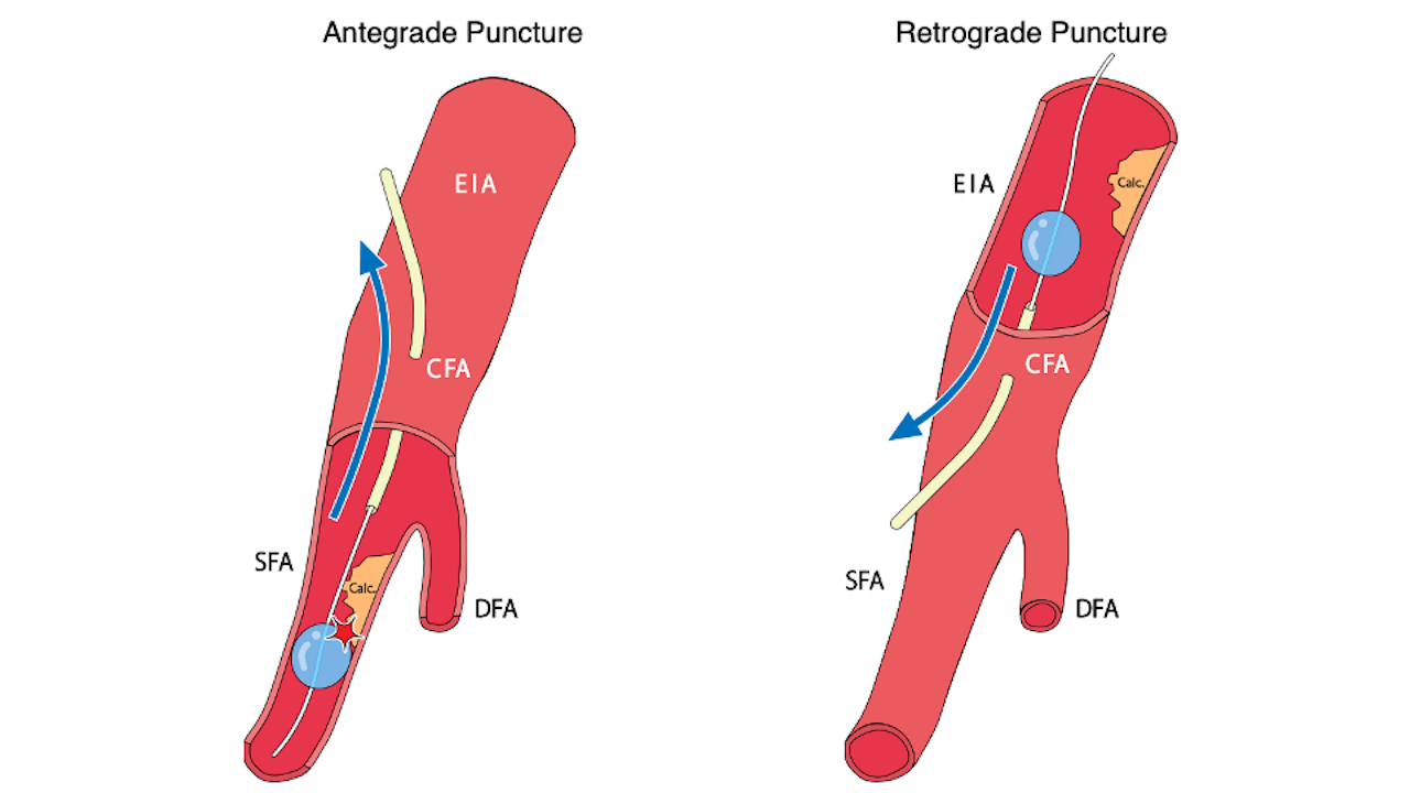 Kazuhiro Figure_mechanism_balloon_rupture_hemostasis_MYNX CONTROL