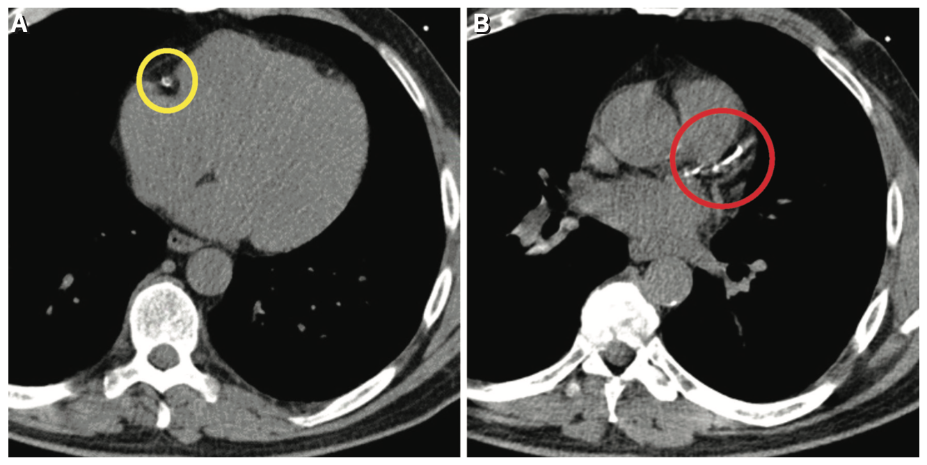 Keimer-Merschen Coronary Artery Disease Figure 1