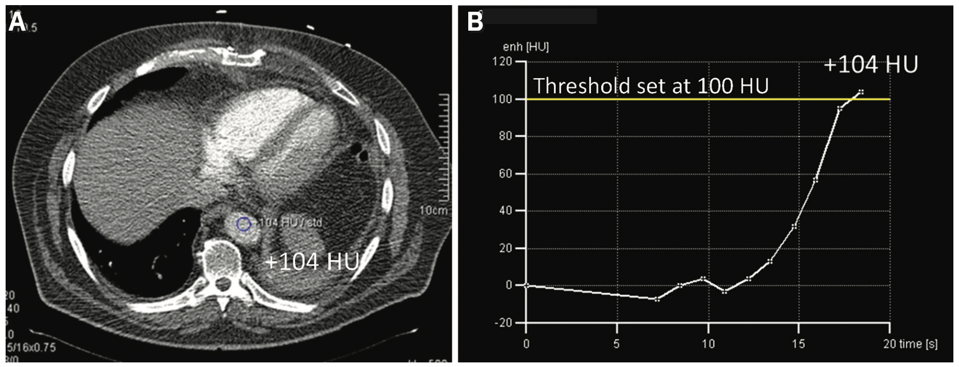 Keimer-Merschen Coronary Artery Disease Figure 3