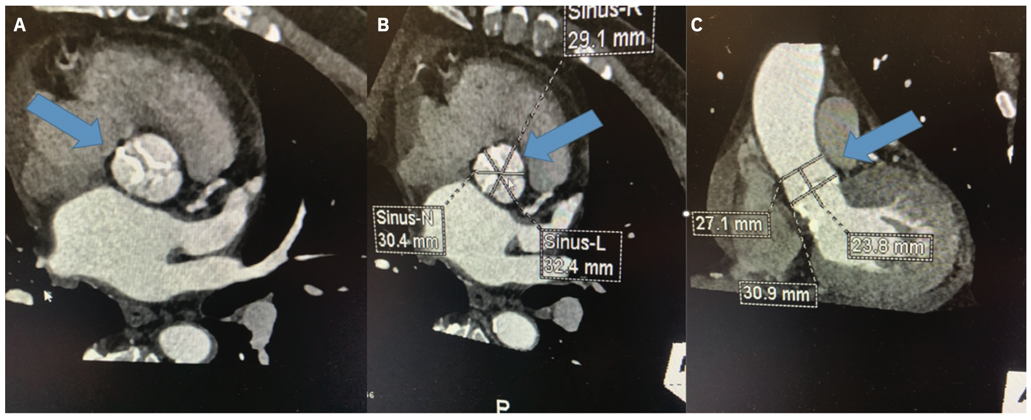 Keimer-Merschen Coronary Artery Disease Figure 6