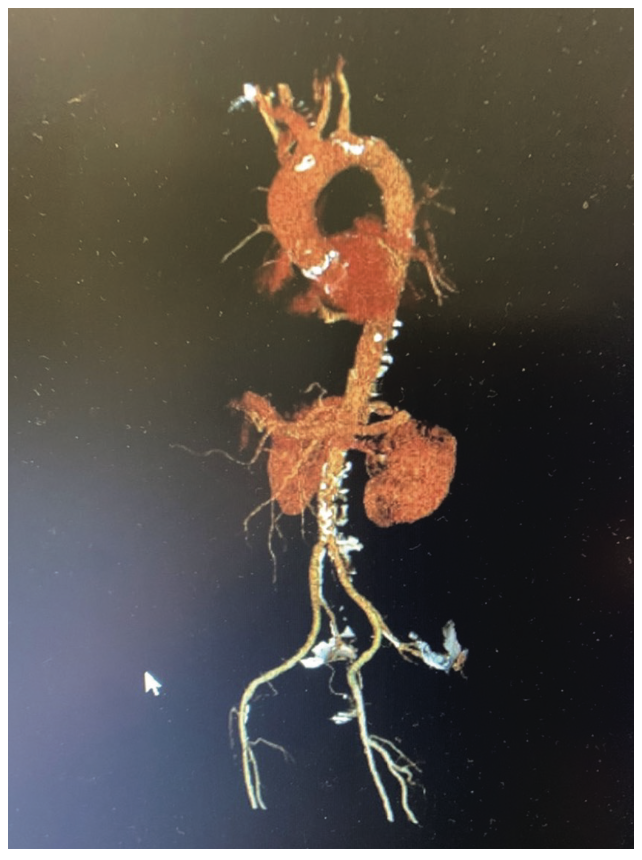 Keimer-Merschen Coronary Artery Disease Figure 7
