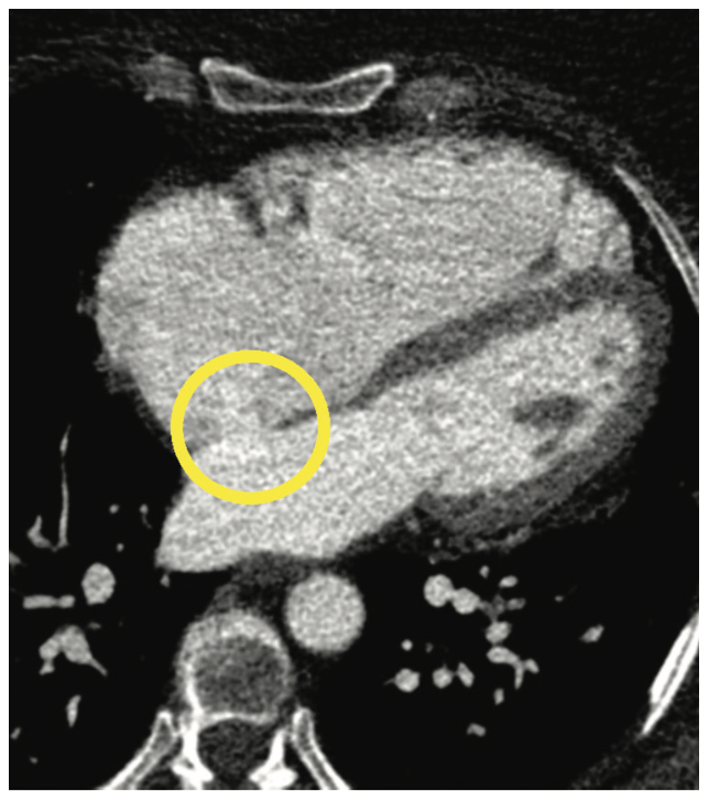 Keimer-Merschen Coronary Artery Disease Figure 9