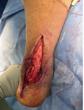 open wound on posterior aspect of the ankle